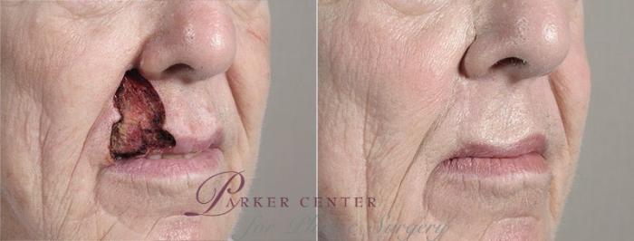 Skin Cancer Treatment Case 1070 Before & After View #2 | Paramus, NJ | Parker Center for Plastic Surgery
