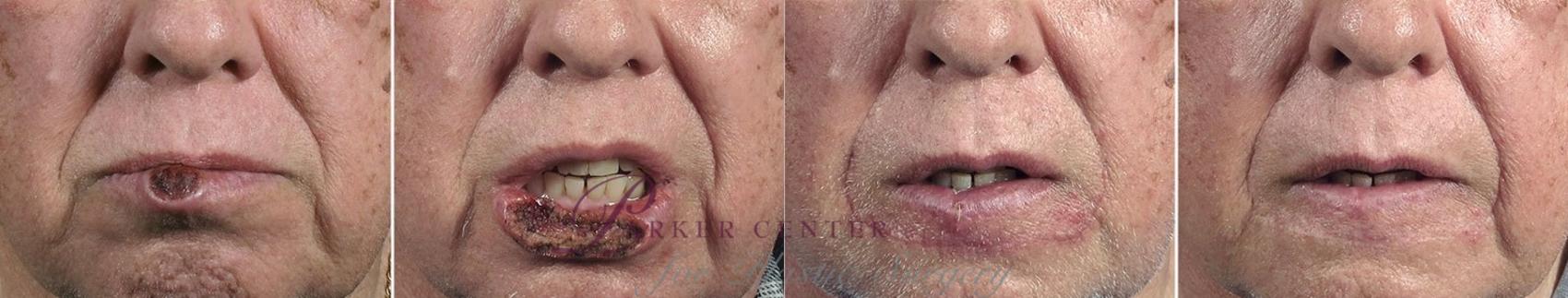 Skin Cancer Treatment Case 1071 Before & After View #2 | Paramus, NJ | Parker Center for Plastic Surgery