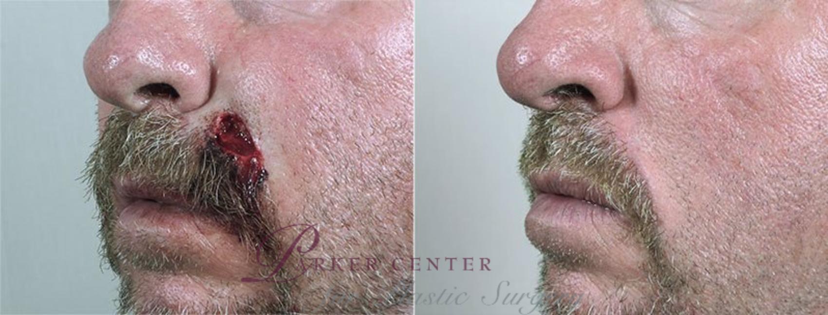 Skin Cancer Treatment Case 1072 Before & After View #1 | Paramus, NJ | Parker Center for Plastic Surgery