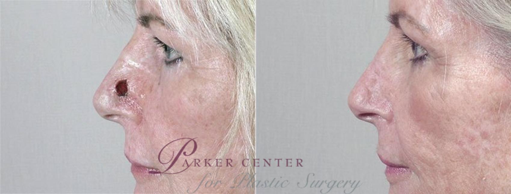 Skin Cancer Treatment Case 1073 Before & After View #1 | Paramus, NJ | Parker Center for Plastic Surgery