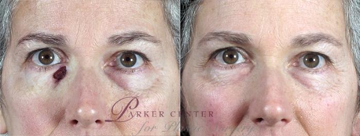 Skin Cancer Treatment Case 1074 Before & After View #1 | Paramus, NJ | Parker Center for Plastic Surgery