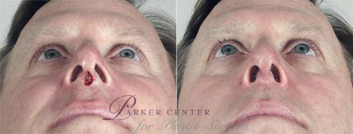 Skin Cancer Treatment Case 1078 Before & After View #1 | Paramus, NJ | Parker Center for Plastic Surgery