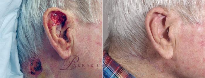 Skin Cancer Treatment Case 1079 Before & After View #1 | Paramus, NJ | Parker Center for Plastic Surgery