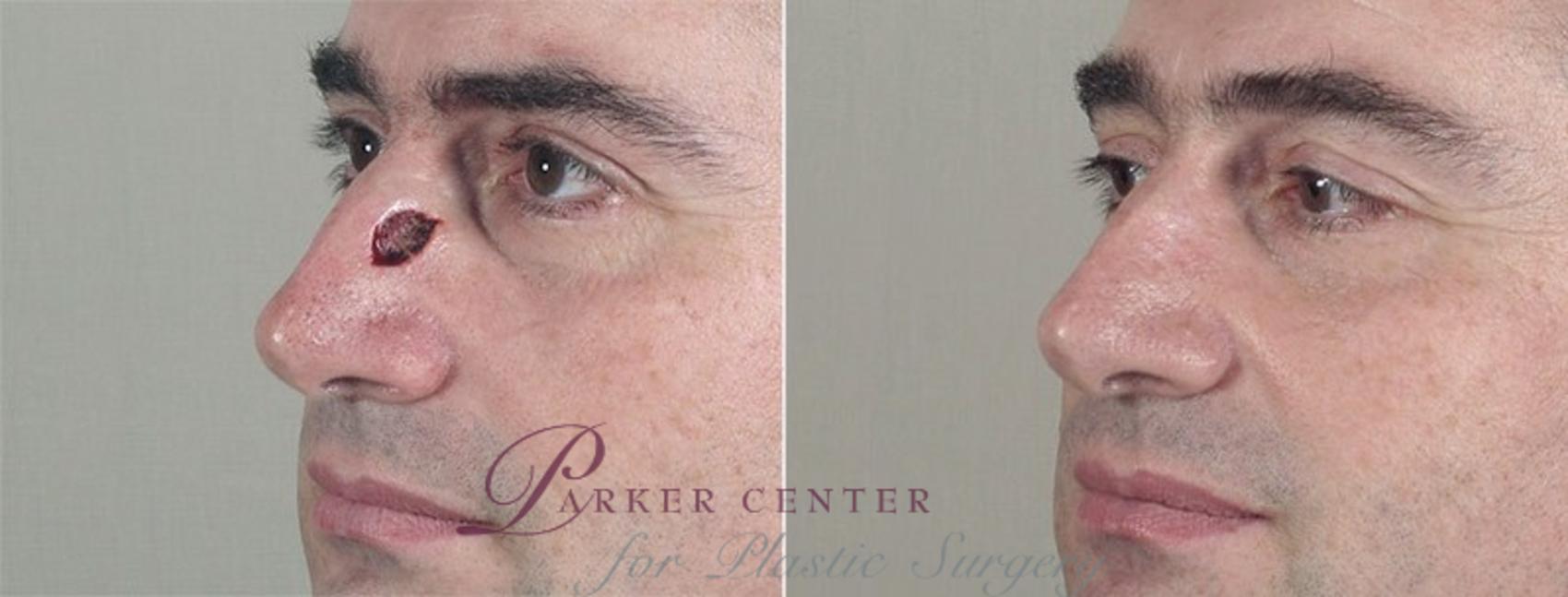 Skin Cancer Treatment Case 1083 Before & After View #1 | Paramus, NJ | Parker Center for Plastic Surgery