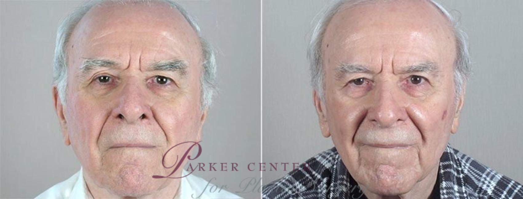 Skin Cancer Treatment Case 1086 Before & After View #2 | Paramus, NJ | Parker Center for Plastic Surgery