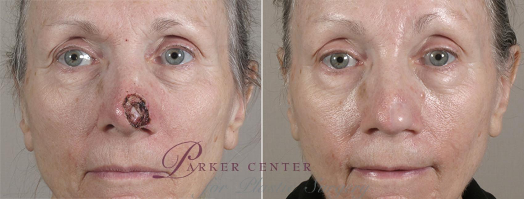 Skin Cancer Treatment Case 1088 Before & After View #1 | Paramus, NJ | Parker Center for Plastic Surgery