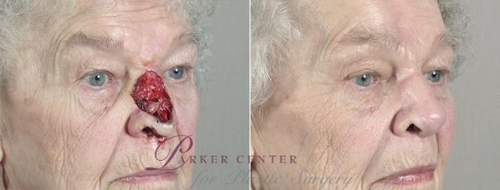 Skin Cancer Treatment Case 1089 Before & After View #2 | Paramus, NJ | Parker Center for Plastic Surgery