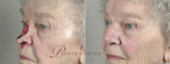Skin Cancer Treatment Case 1089 Before & After View #3 | Paramus, NJ | Parker Center for Plastic Surgery