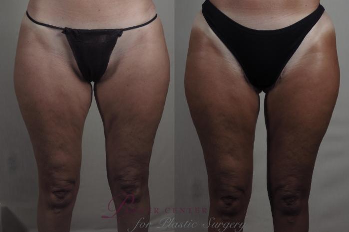 Anterior Thigh Liposuction or Lift: Which To Opt For