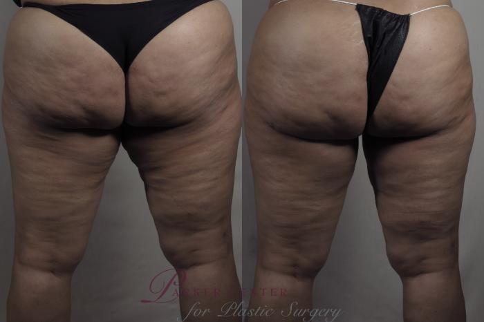 Liposuction Case 1275 Before & After Back | Paramus, NJ | Parker Center for Plastic Surgery