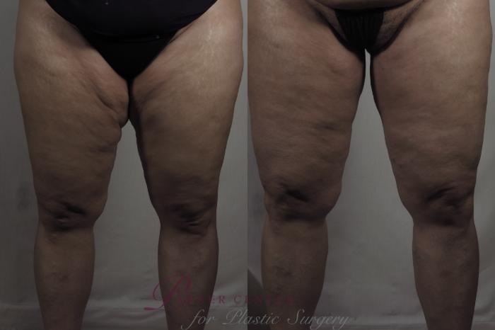 Thigh Lift Case 1275 Before & After Front | Paramus, NJ | Parker Center for Plastic Surgery