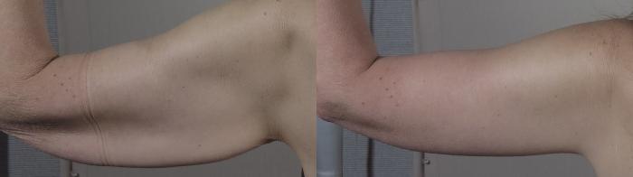 Thigh Lift Case 1304 Before & After back arms | Paramus, New Jersey | Parker Center for Plastic Surgery