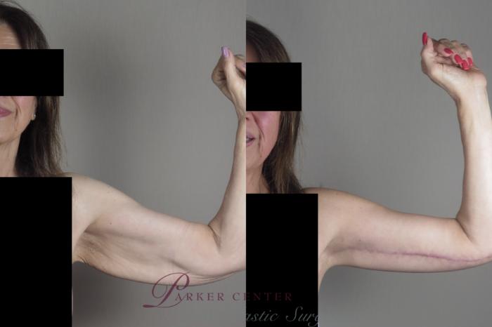 Liposuction Case 1304 Before & After front  | Paramus, NJ | Parker Center for Plastic Surgery