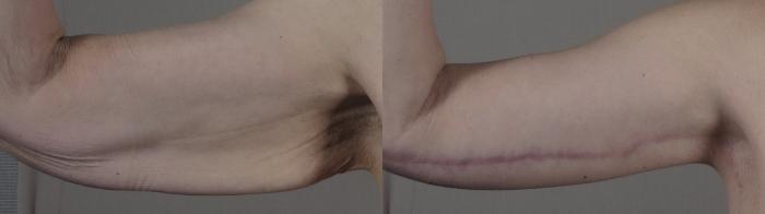 Thigh Lift Case 1304 Before & After front arm | Paramus, New Jersey | Parker Center for Plastic Surgery