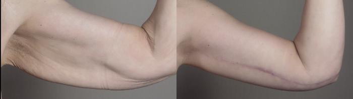 Thigh Lift Case 1304 Before & After front arms 2 | Paramus, New Jersey | Parker Center for Plastic Surgery