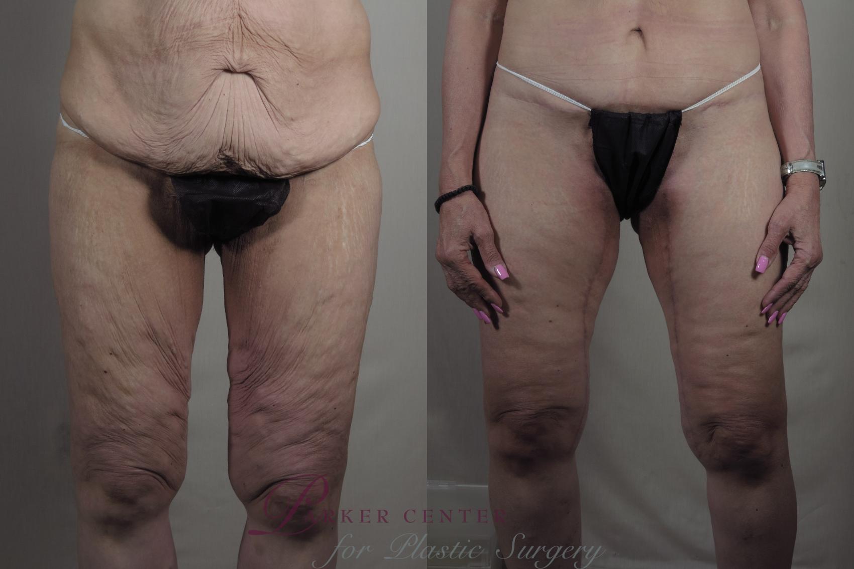 Liposuction Case 1304 Before & After Front | Paramus, NJ | Parker Center for Plastic Surgery
