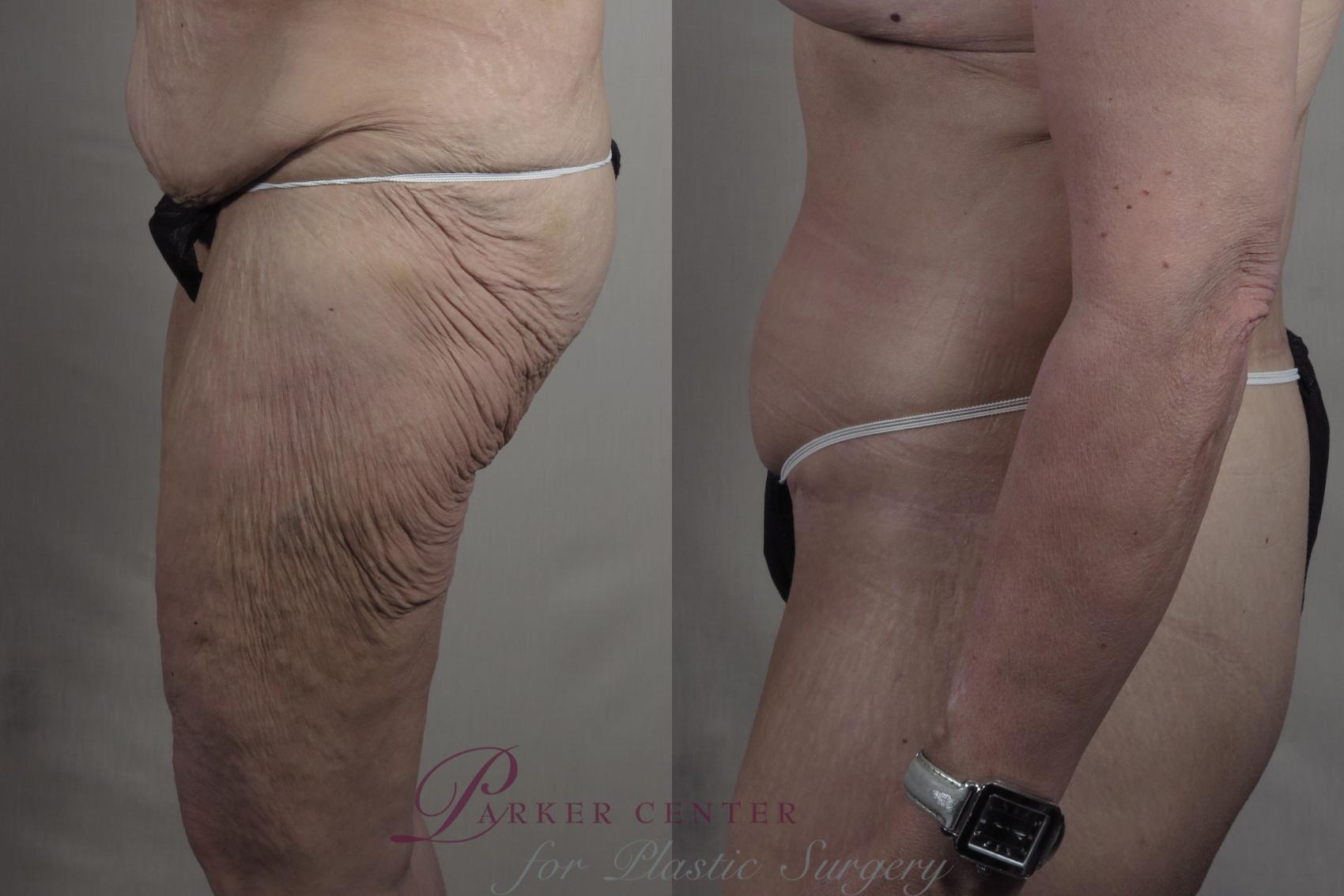 Thigh Lift Case 1304 Before & After Left Side | Paramus, New Jersey | Parker Center for Plastic Surgery