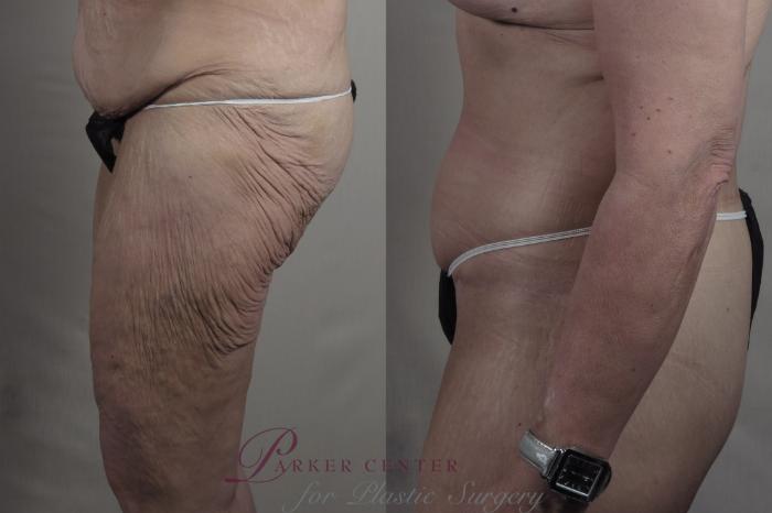 Thigh Lift Case 1304 Before & After Left Side | Paramus, NJ | Parker Center for Plastic Surgery
