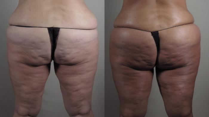 Thigh Lift Case 1521 Before & After Back | Paramus, New Jersey | Parker Center for Plastic Surgery