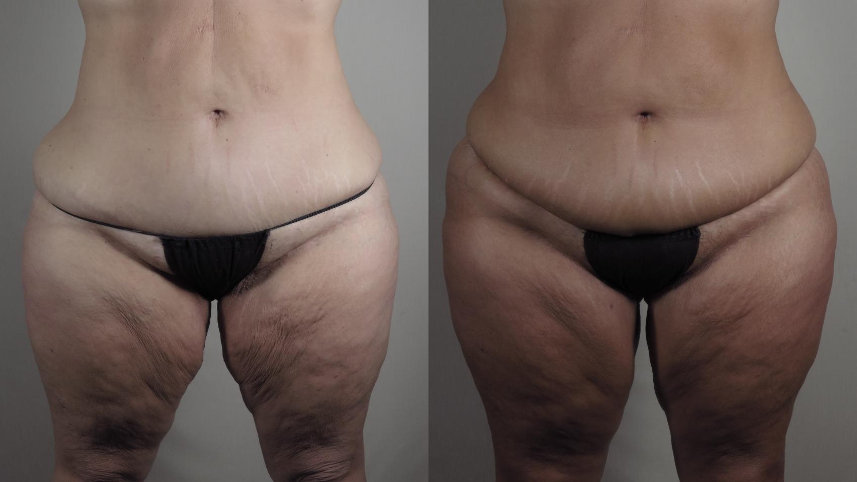 Thigh Lift Case 1521 Before & After Front | Paramus, New Jersey | Parker Center for Plastic Surgery