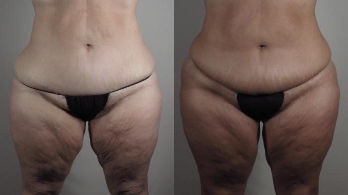 Thigh Lift Case 1521 Before & After Front | Paramus, New Jersey | Parker Center for Plastic Surgery