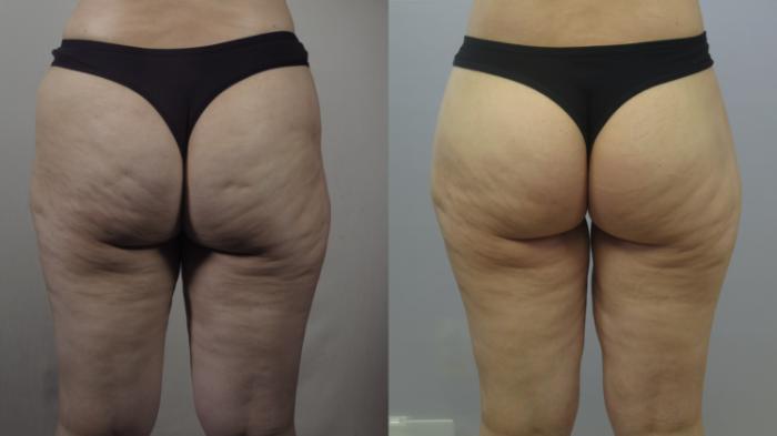 Thigh Lift Case 1605 Before & After Back | Paramus, New Jersey | Parker Center for Plastic Surgery