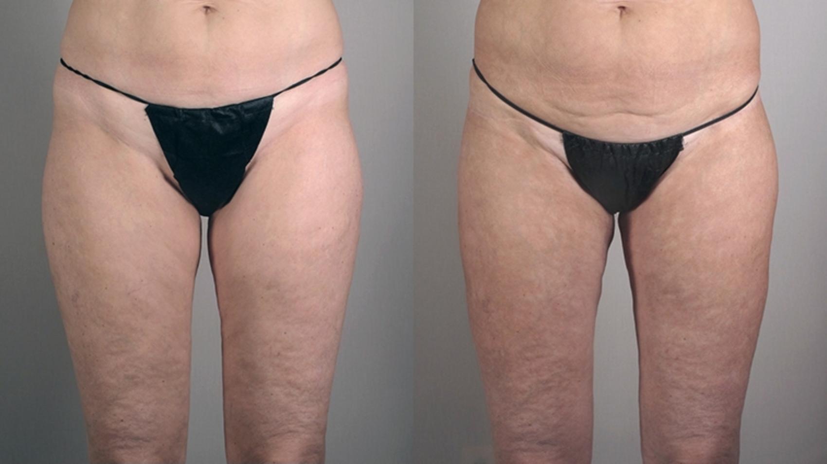 Thigh Lift Case 752 Before & After View #2 | Paramus, New Jersey | Parker Center for Plastic Surgery