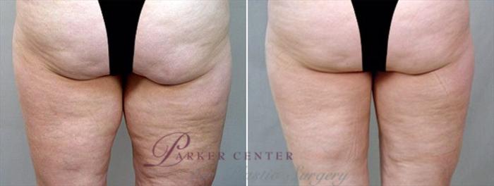 Thigh Lift Case 757 Before & After View #2 | Paramus, NJ | Parker Center for Plastic Surgery