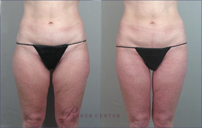Thigh Lift Case 770 Before & After View #1 | Paramus, NJ | Parker Center for Plastic Surgery