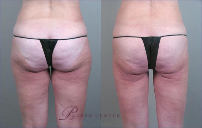 Thigh Lift Case 770 Before & After View #2 | Paramus, NJ | Parker Center for Plastic Surgery