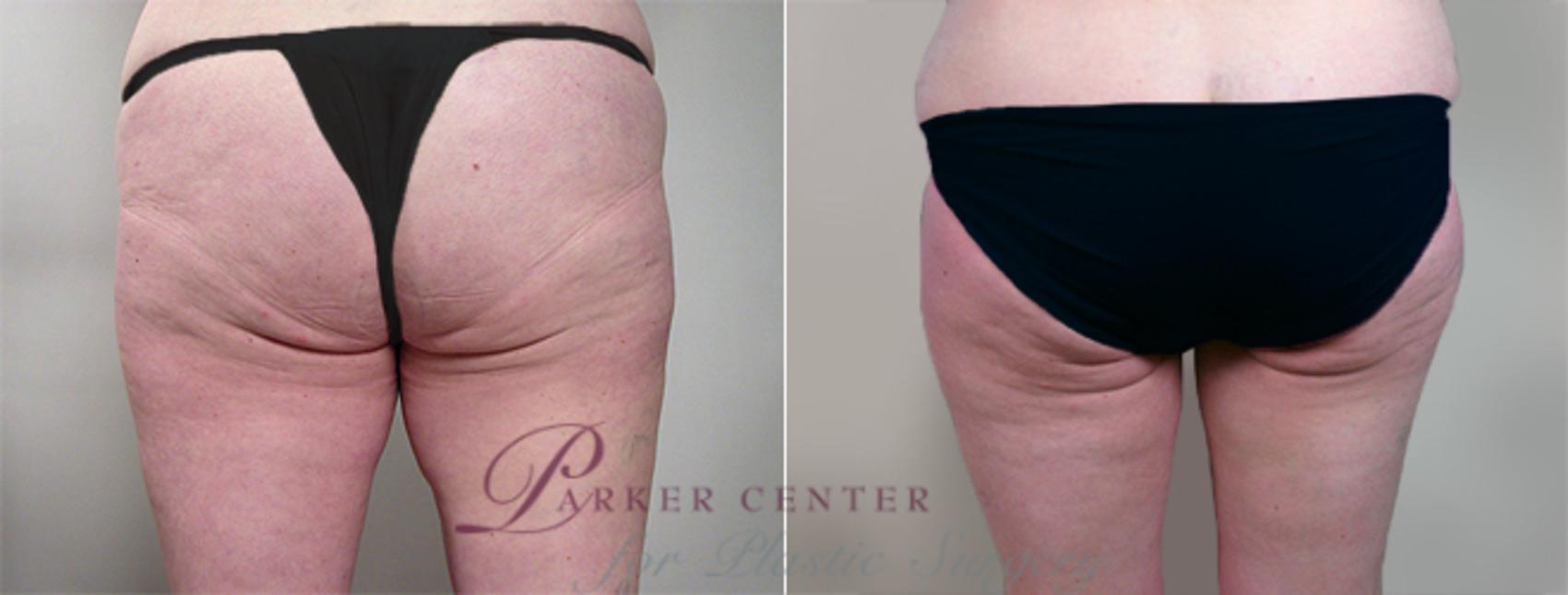 Thigh Lift Case 817 Before & After View #2 | Paramus, New Jersey | Parker Center for Plastic Surgery