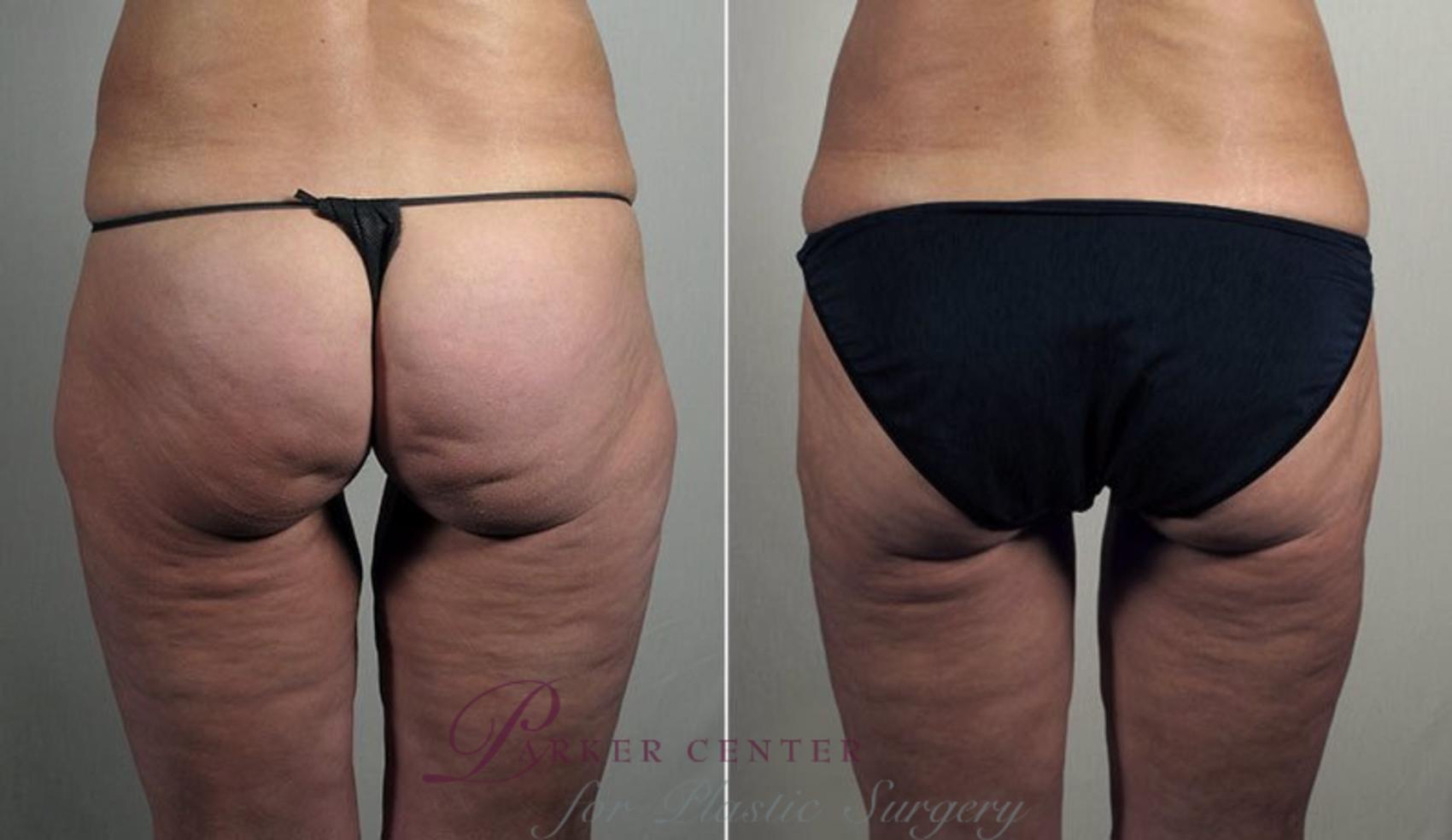 Thigh Lift Case 820 Before & After View #2 | Paramus, New Jersey | Parker Center for Plastic Surgery