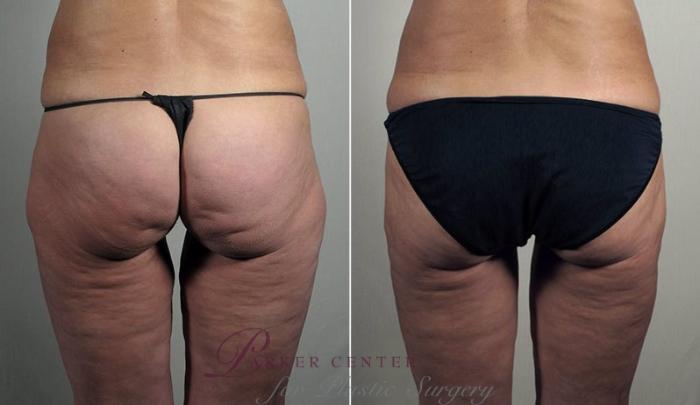Thigh Lift Gallery - Before and After