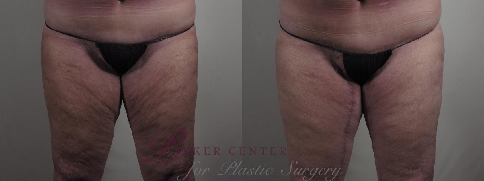 Thigh Lift Case 978 Before & After Front | Paramus, NJ | Parker Center for Plastic Surgery