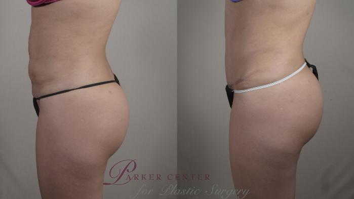 Tummy Tuck Case 1006 Before & After Right Side | Paramus, NJ | Parker Center for Plastic Surgery