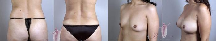 Liposuction Case 1101 Before & After Back | Paramus, NJ | Parker Center for Plastic Surgery