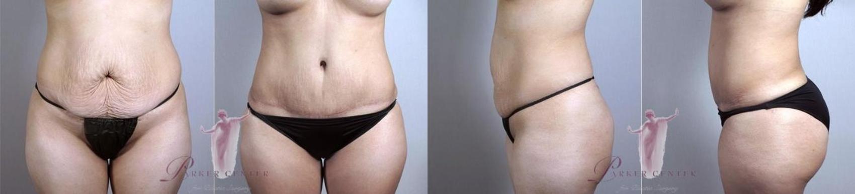 Liposuction Case 1101 Before & After Front | Paramus, NJ | Parker Center for Plastic Surgery