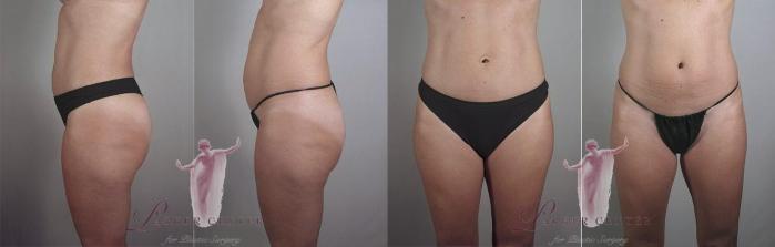 Tummy Tuck Case 1107 Before & After Front | Paramus, New Jersey | Parker Center for Plastic Surgery