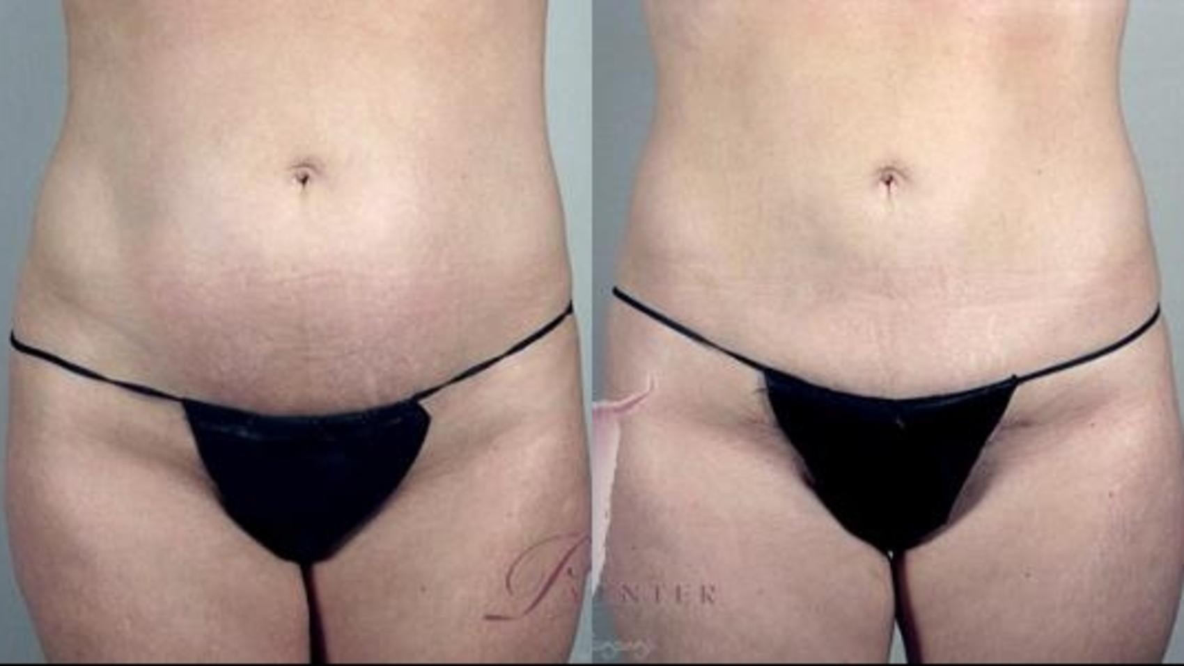 Liposuction Case 1109 Before & After Front | Paramus, NJ | Parker Center for Plastic Surgery