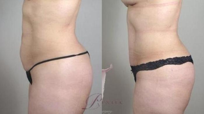 Tummy Tuck Case 1111 Before & After Left Side | Paramus, New Jersey | Parker Center for Plastic Surgery