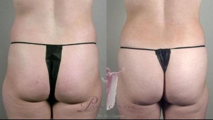 Tummy Tuck Case 1118 Before & After Back | Paramus, New Jersey | Parker Center for Plastic Surgery