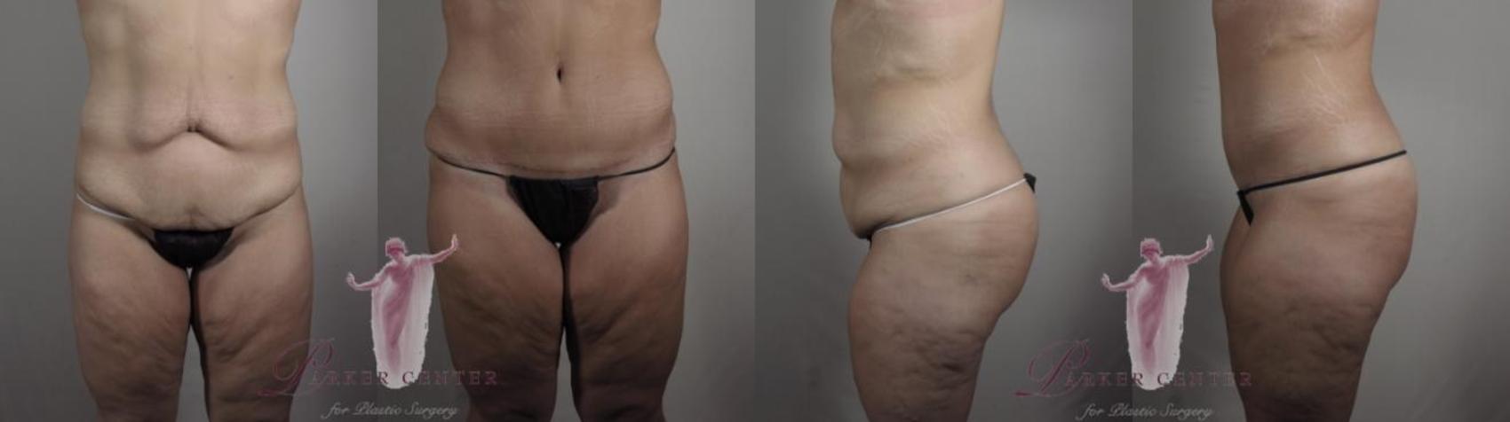 Tummy Tuck Case 1121 Before & After Front | Paramus, NJ | Parker Center for Plastic Surgery