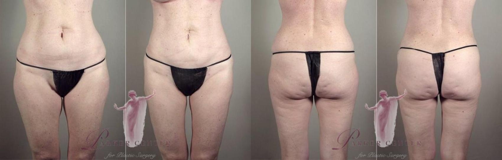 Tummy Tuck Case 1125 Before & After Front | Paramus, New Jersey | Parker Center for Plastic Surgery