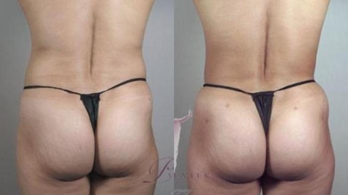 Tummy Tuck Case 1130 Before & After Back | Paramus, New Jersey | Parker Center for Plastic Surgery