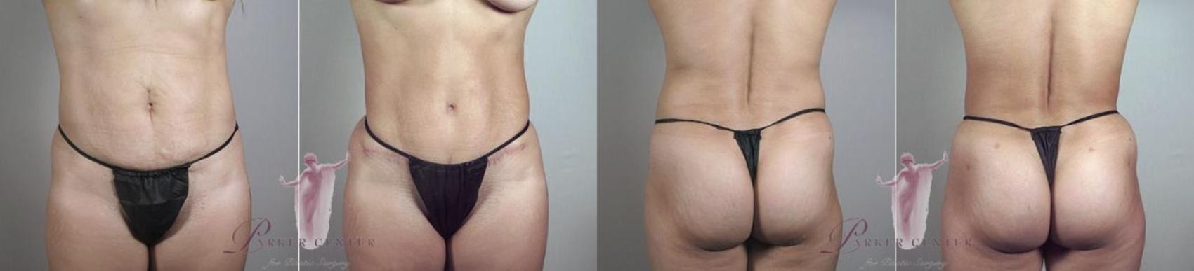 Liposuction Case 1130 Before & After Front | Paramus, NJ | Parker Center for Plastic Surgery