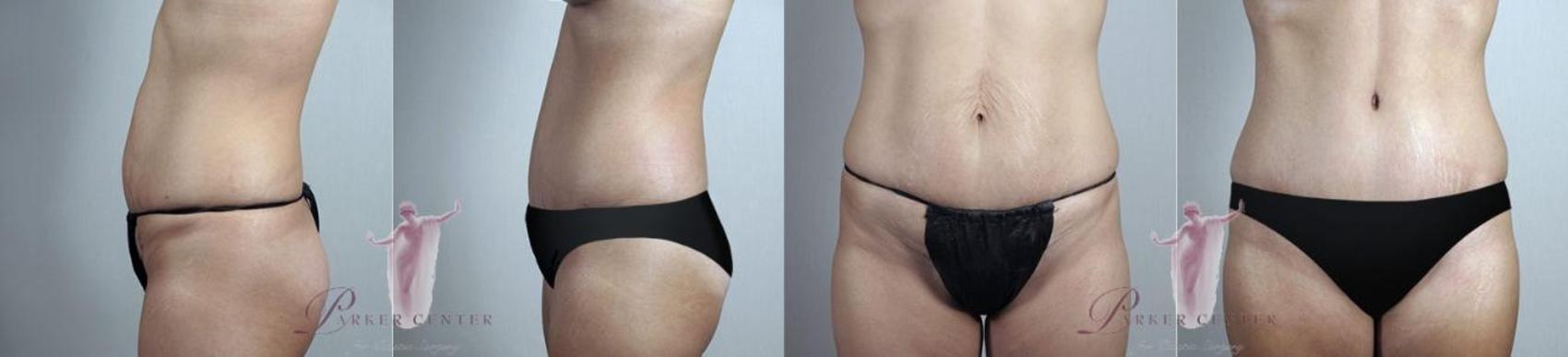 Tummy Tuck Case 1131 Before & After Front | Paramus, NJ | Parker Center for Plastic Surgery