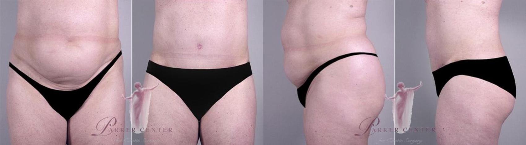 Liposuction Case 1133 Before & After Front | Paramus, NJ | Parker Center for Plastic Surgery