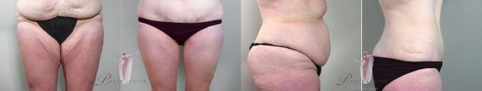 Liposuction Case 1135 Before & After Front | Paramus, NJ | Parker Center for Plastic Surgery