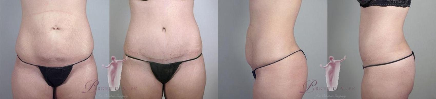 Tummy Tuck Case 1136 Before & After Front | Paramus, NJ | Parker Center for Plastic Surgery