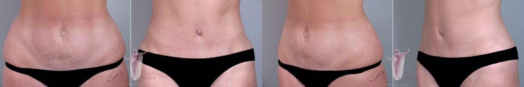 Tummy Tuck Case 1137 Before & After Front | Paramus, NJ | Parker Center for Plastic Surgery